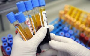 Um exame de sangue pode diagnosticar cancer de rim
