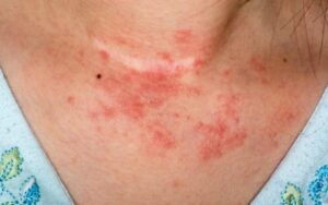 Diferenca entre eczema e dermatite
