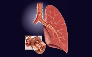 Enfisema vs. Doenca pulmonar obstrutiva cronica