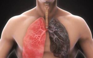 O que saber sobre hiperinsuflacao dos pulmoes