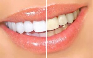 Segredos para dentes mais brilhantes e brancos