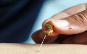 Como remover um ferrao de abelha e tratar o ferrao