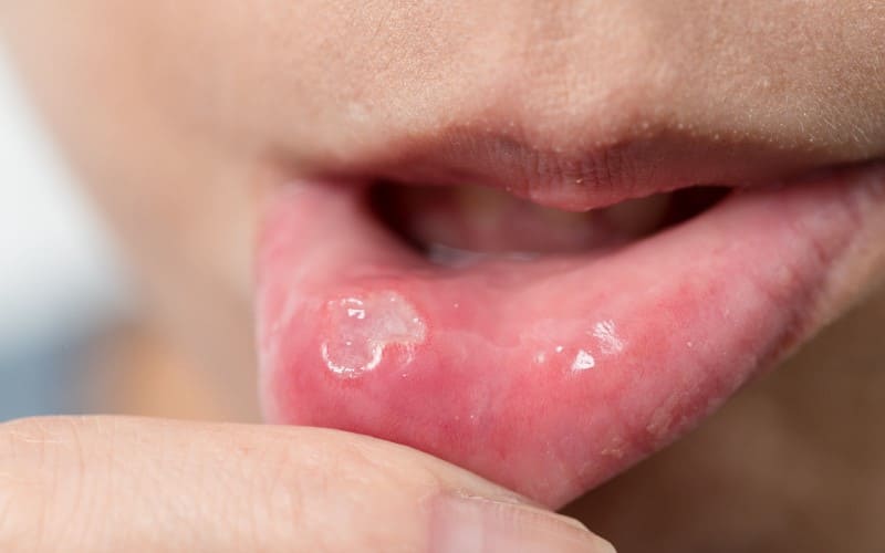 Tratando o herpes labial nos estagios iniciais
