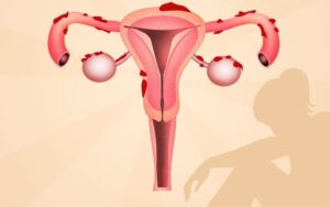 Mitos medicos sobre endometriose