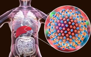 O que e hepatite D e quais seus sintomas
