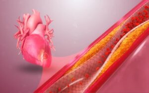 Sintomas e diagnostico da sindrome coronariana aguda