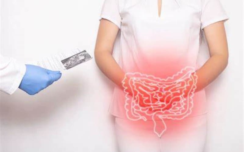 Retocolite ulcerativa e a doença de Crohn