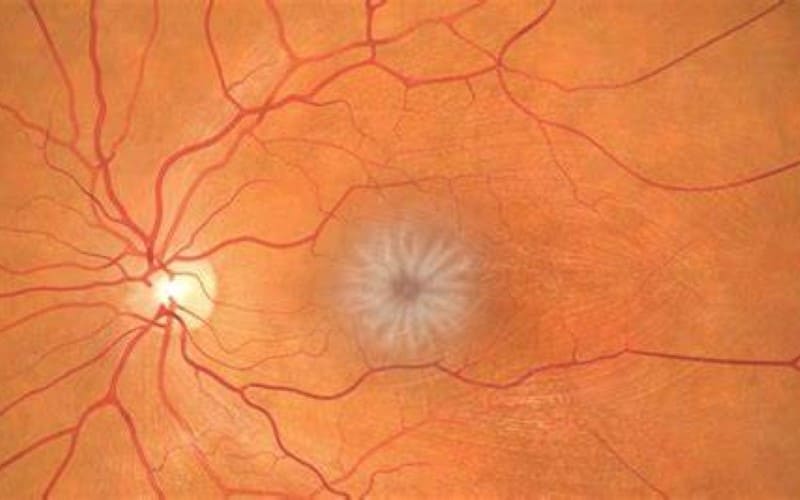 O que saber sobre edema macular diabético