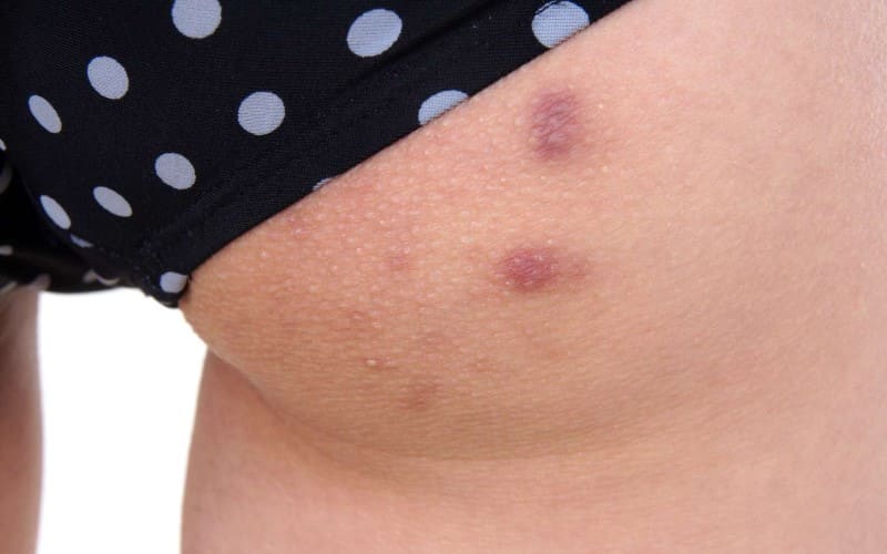 Prevencao e tratamento da acne no bumbum