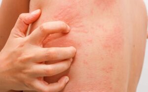 O que saber sobre alergias à beladona