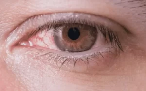 O que é essa vermelhidão no meu olho
