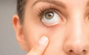 O que você não sabe sobre a síndrome do olho seco