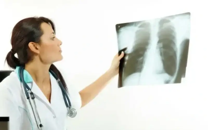 Quais São os Sintomas e Tratamento da Embolia Pulmonar