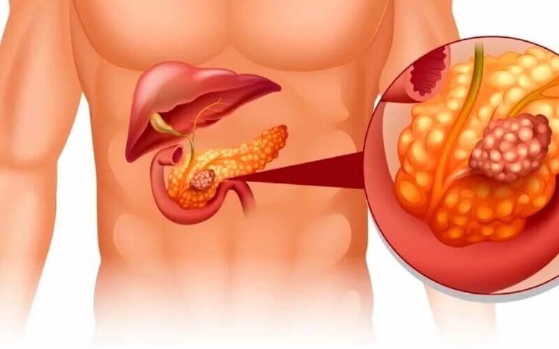 Transtornos Alimentares afetam a função pancreática