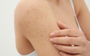 Jejum Intermitente pode afetar minha saúde da pele