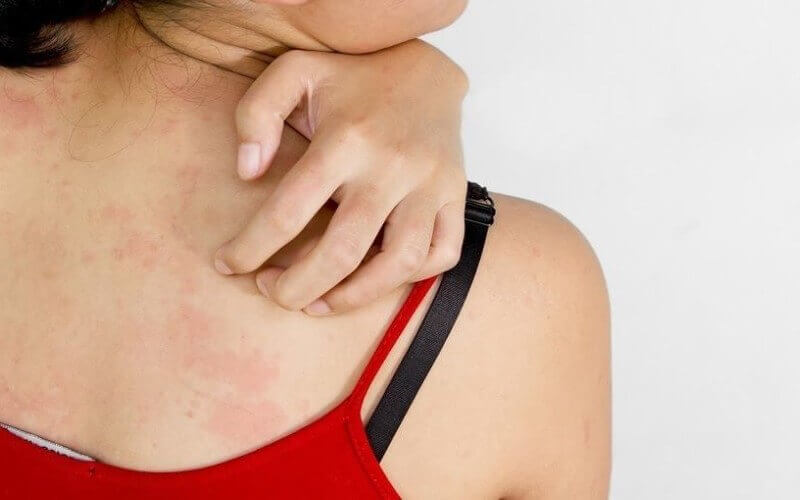 O Jejum Intermitente aumenta o risco de alergias