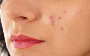 O Jejum Intermitente pode causar acne