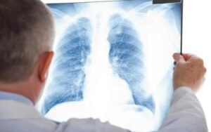 Quais são os efeitos dos Transtornos Alimentares na função pulmonar