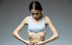 Quais são os sintomas de Anorexia Nervosa