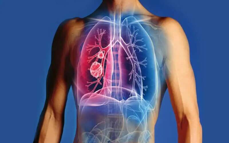 O que são problemas pulmonares