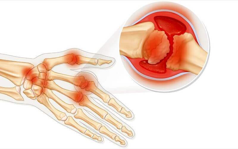 Quais são as causas da artrite reumatoide