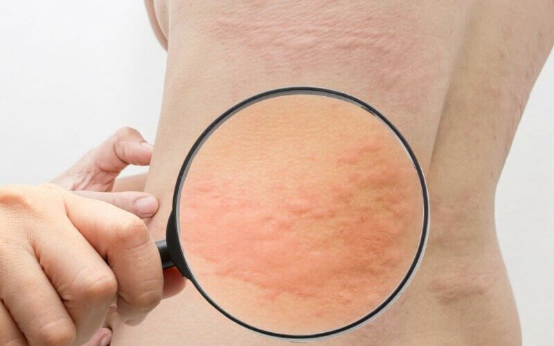 Quais são os sintomas comuns de alergias