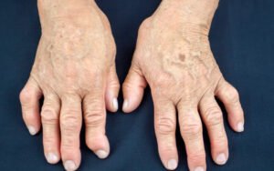 Quais são os sintomas da artrite reumatoide