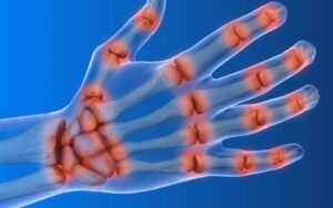 Quem está mais suscetível a desenvolver artrite reumatoide