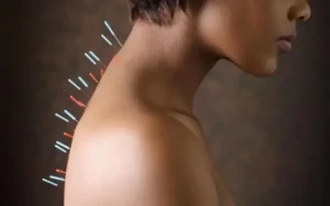 A acupuntura pode acabar com sua dor nas costas