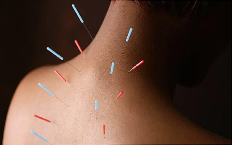 A acupuntura pode ajudar no tratamento da tireoide