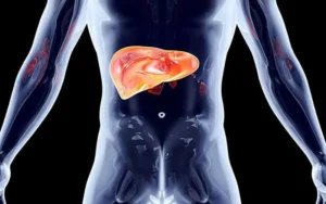 O que é a esteatose hepática (fígado gordo)