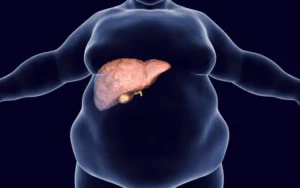 O que é fígado gorduroso