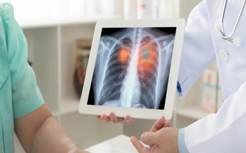 Quais são os sintomas do câncer de pulmão