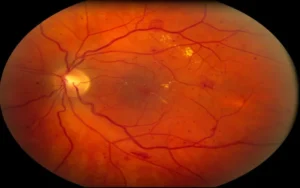 Como tratar a retinopatia diabética