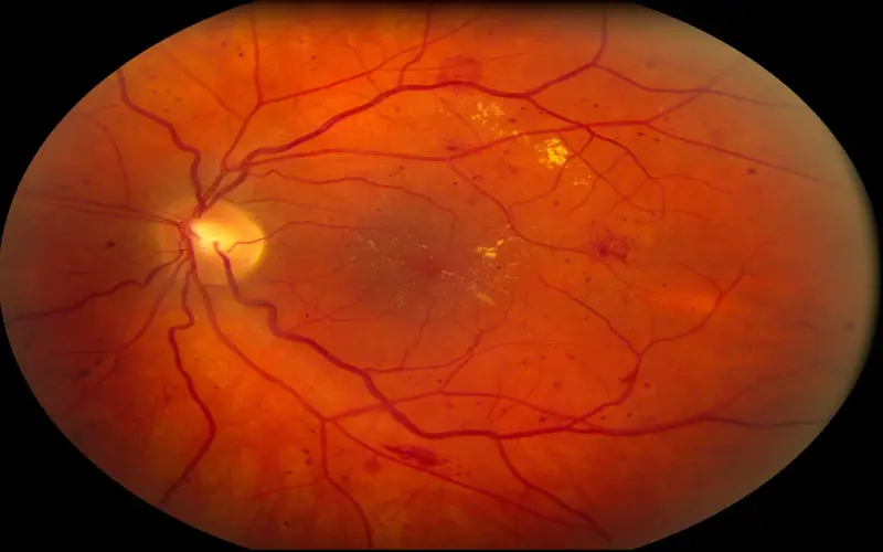 Como tratar a retinopatia diabética