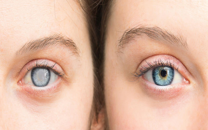 Person with white pupil and healthy eye comparison close up